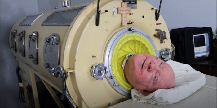 Mars : Lâhomme qui vivait dans un poumon de fer est mort