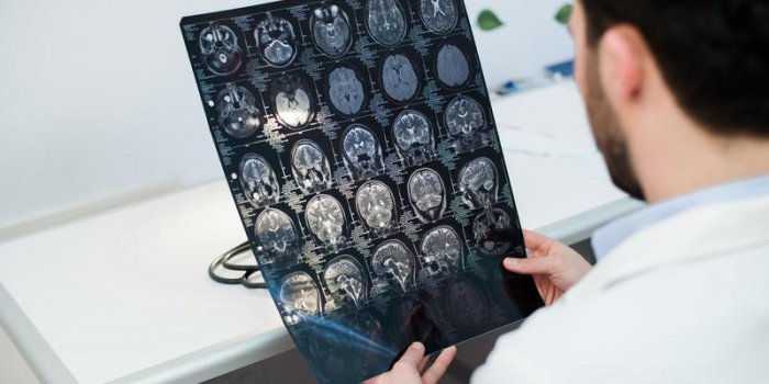 Comment réparer une malformation artério-veineuse dans le cerveau : les images au bloc