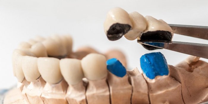 Extraction de dent(s) : Quelles peuvent Ãªtre les complications ?