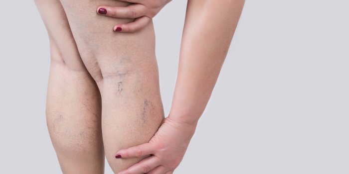 the old age and sick of a woman varicose veins on a legs of woman the varicosity, spider veins, edema, illness concept