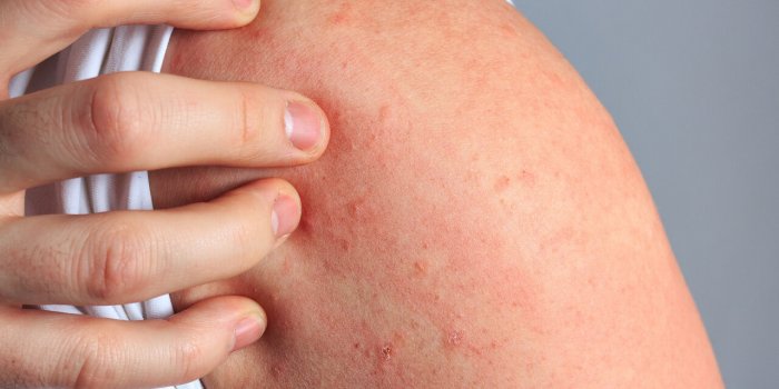 Ãté : 5 problèmes de santé courants à cette période