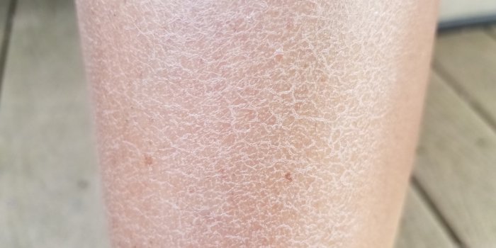 Carence en vitamine C : les 15 symptômes dâalerte
