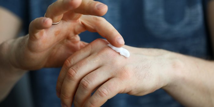 Ådème : 7 astuces contre les mains qui gonflent