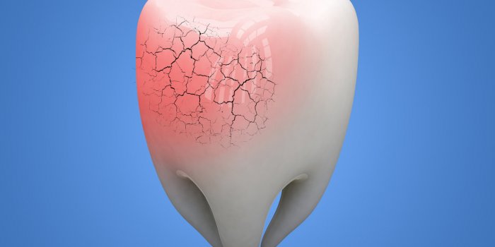 Bruxisme : les signes que vous grincez des dents la nuit