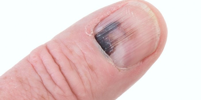 Ongles : ce que leur couleur signifie de votre état de santé