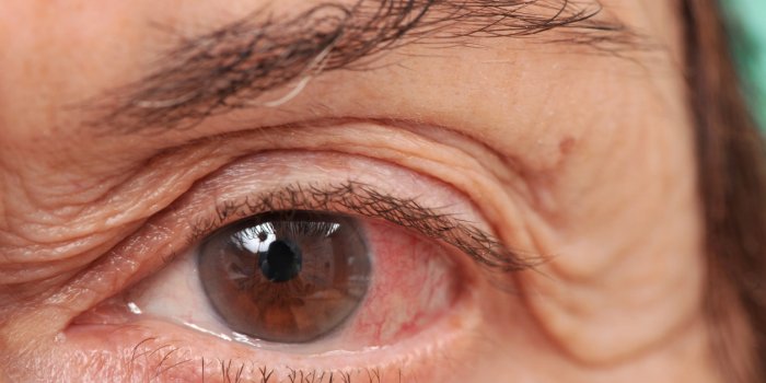 11 maladies qui donnent les yeux rouges