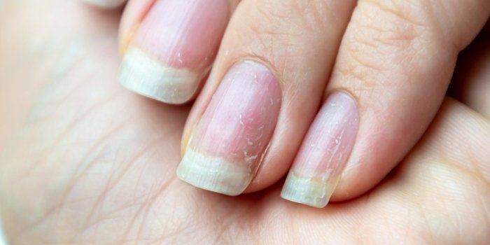 Pour savoir si vous avez vaincu la Covid-19, regardez vos ongles