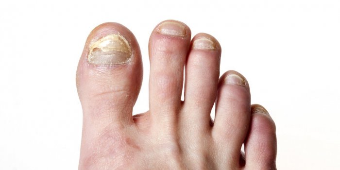 Pour savoir si vous avez vaincu la Covid-19, regardez vos ongles