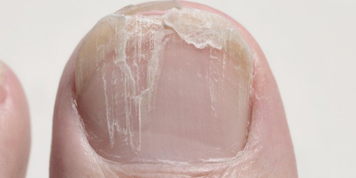 Pour savoir si vous avez vaincu la Covid-19, regardez vos ongles