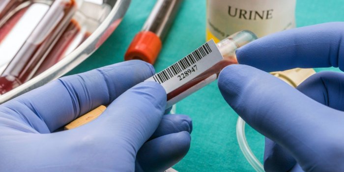Calcul rénal : les symptômes d'alerte à prendre au sérieux