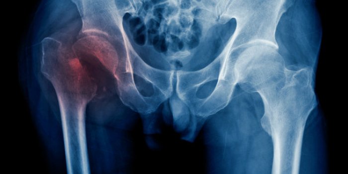 Vitamine K : 6 signes que vous souffrez dâune carence