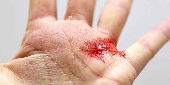 RandonnÃ©e : 7 astuces pour soigner les blessures les plus frÃ©quentes