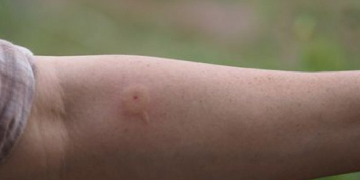 PHOTOS : Comment différencier ces 7 piqûres d'insectes ?