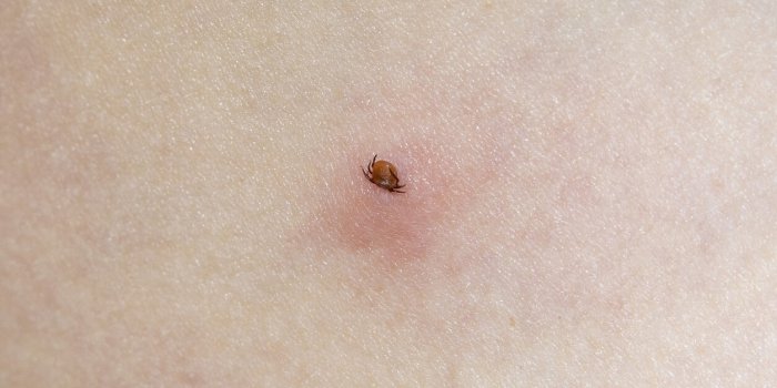 PHOTOS : Comment différencier ces 7 piqûres d'insectes ?