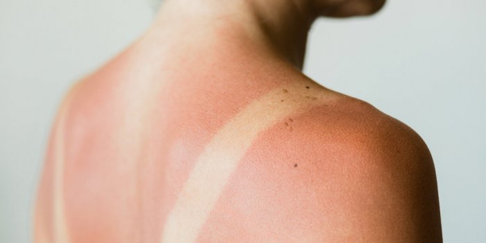 Coup de soleil : 8 conseils dâune dermatologue pour les apaiser et dérougir
