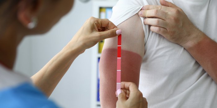 Coup de soleil : 8 conseils dâune dermatologue pour les apaiser et dérougir
