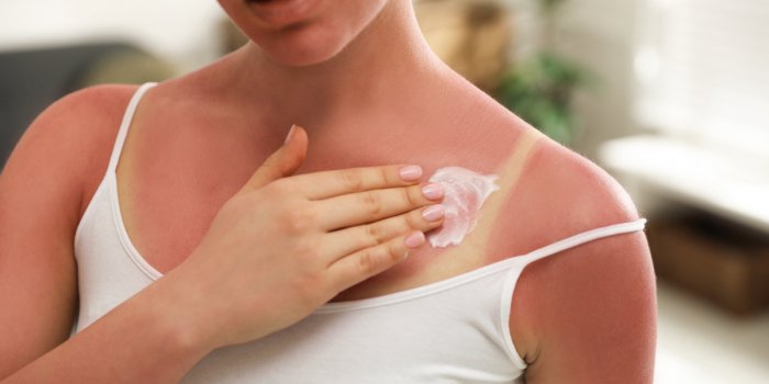 Coup de soleil : 8 conseils dâune dermatologue pour les apaiser et dérougir