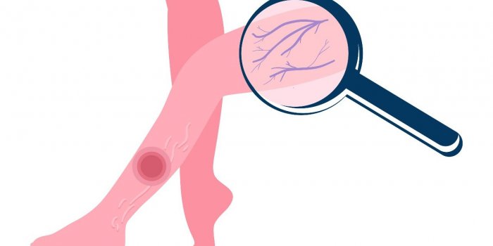 Jambes lourdes : 5 mauvaises habitudes qui favorisent lâinsuffisance veineuse