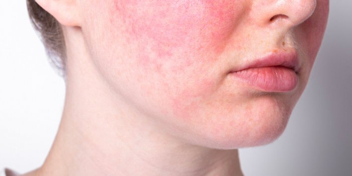 StÃ©atose hÃ©patique non alcoolique : 5 signes Ã  repÃ©rer sur le visage