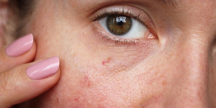StÃ©atose hÃ©patique non alcoolique : 5 signes Ã  repÃ©rer sur le visage