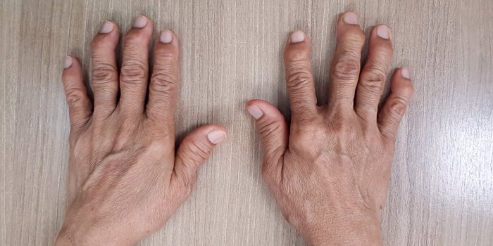 Syndrome douloureux rÃ©gional complexe : ces symptÃ´mes mÃ©connus qui accompagnent la douleur