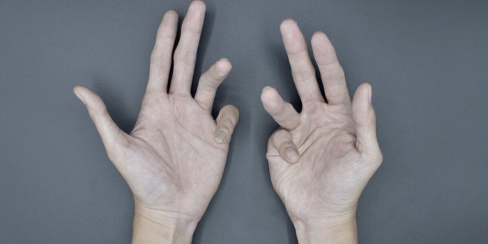 Syndrome douloureux rÃ©gional complexe : ces symptÃ´mes mÃ©connus qui accompagnent la douleur