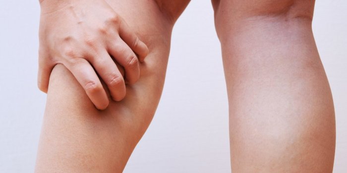 Varice : 5 signes qui doivent alerter selon un chirurgien vasculaire