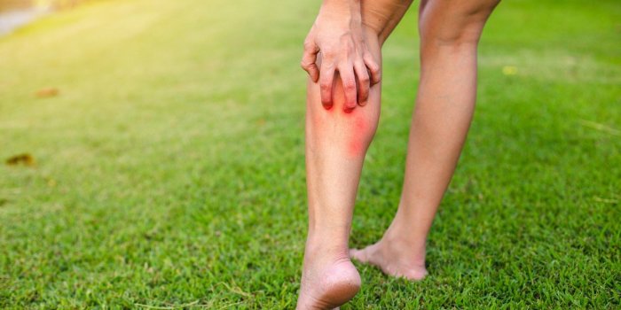 Varice : 5 signes qui doivent alerter selon un chirurgien vasculaire