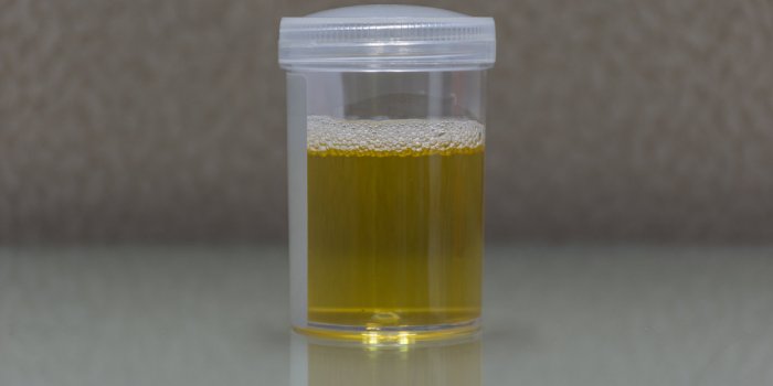 Urine : les couleurs qui doivent vous alerter
