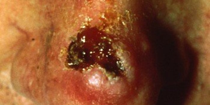 Cancer de la peau : quelles sont les rÃ©gions les plus Ã  risque ?