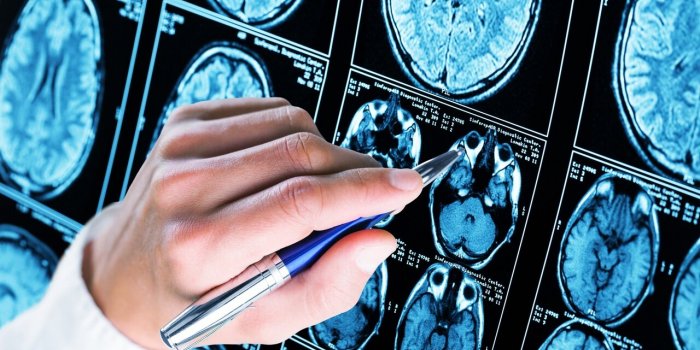 Démence : 5 formes différentes que vous pouvez avoir