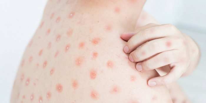 Ces maladies infantiles qui peuvent être graves chez lâadulte