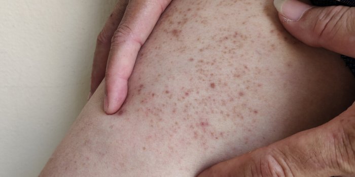 Ces maladies infantiles qui peuvent être graves chez lâadulte