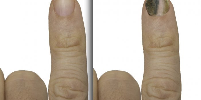Cancer : plusieurs signes peuvent apparaitre sur vos ongles
