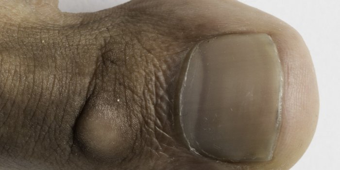 Cancer : plusieurs signes peuvent apparaitre sur vos ongles
