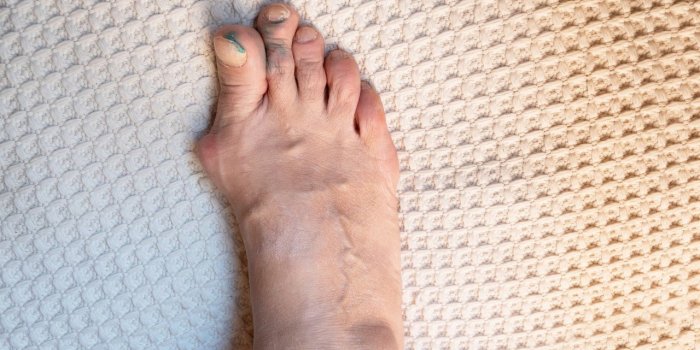 Cancer : plusieurs signes peuvent apparaitre sur vos ongles