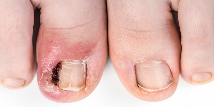 Cancer : plusieurs signes peuvent apparaitre sur vos ongles