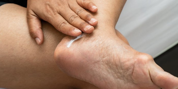 Pieds : 8 astuces pour Ã©viter les ampoules en Ã©tÃ©