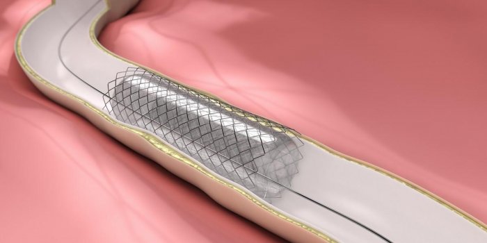 AVC, anévrisme⦠la fabrication des stents et des cathéters en images