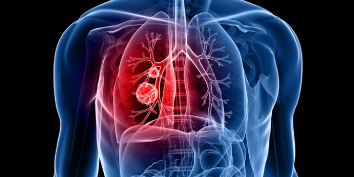 7 cancers difficiles Ã  repÃ©rer Ã  un stade prÃ©coce