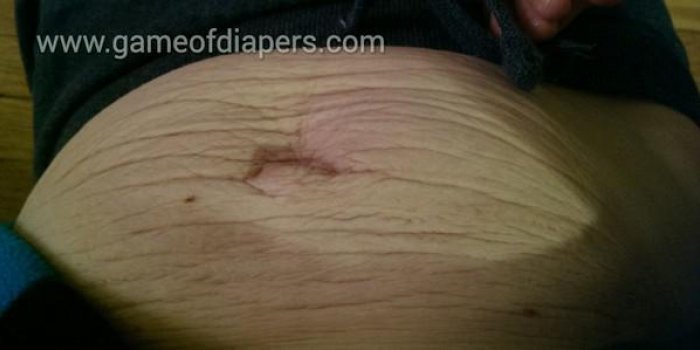 La peau distendue aprÃ¨s la grossesse
