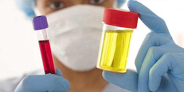 Cancer de la vessie : 6 symptÃ´mes visibles Ã  l'Åil nu 
