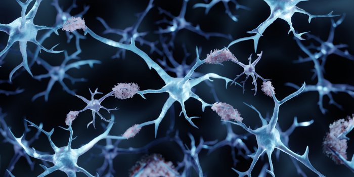 3d illustration showing amyloid plaques in alzheimer's disease