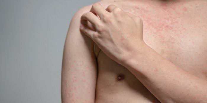 Ces 7 maladies anciennes font leur retour