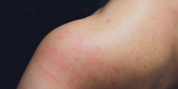 Vaccin Johnson & Johnson : Ã quels effets secondaires doit-on s'attendre ?