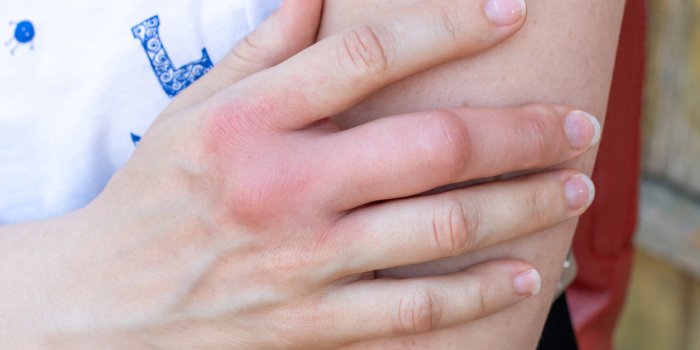 Vaccin contre la Covid-19 : 7 effets sur la peau Ã  surveiller