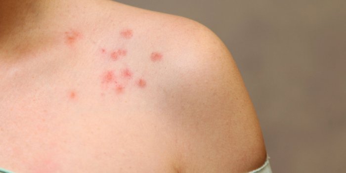 Vaccin contre la Covid-19 : 7 effets sur la peau Ã  surveiller