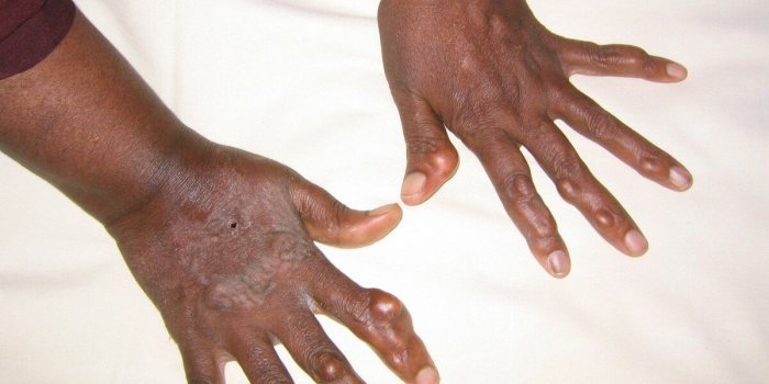 Maladies cardiovasculaires : 7 signes insoupÃ§onnÃ©s