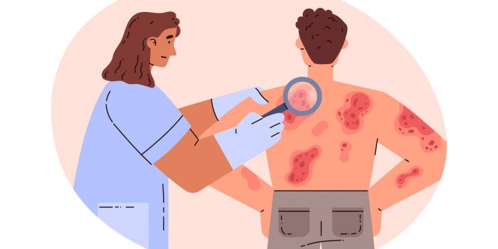 Psoriasis en gouttes : sept signes de cette maladie de la peau