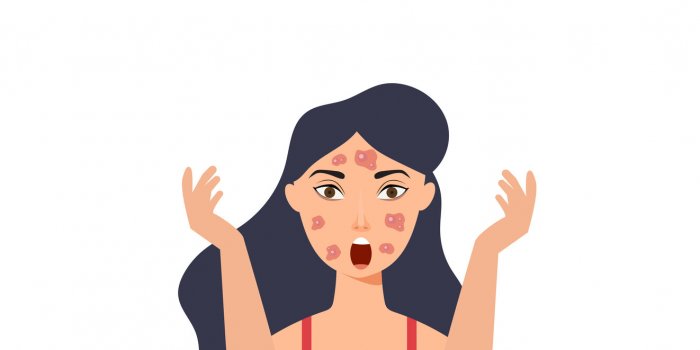 Psoriasis en gouttes : sept signes de cette maladie de la peau
